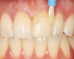 New Options for Professional Tooth Cleaning